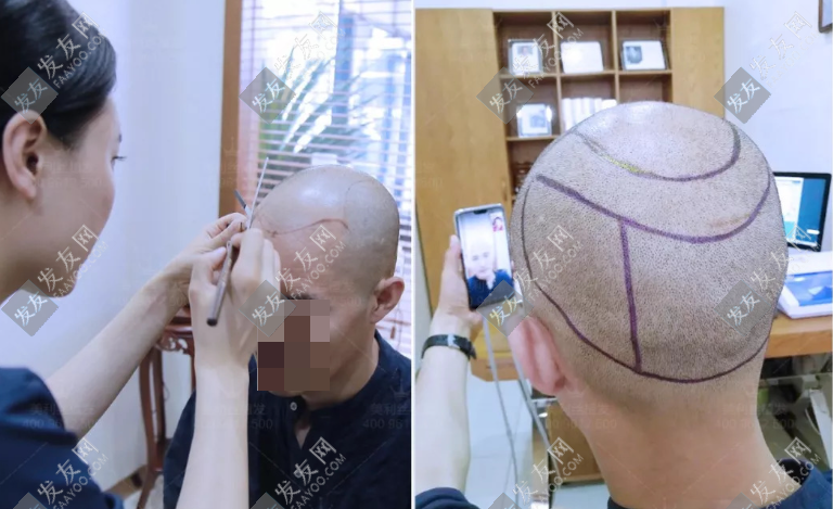 德州植發(fā)醫(yī)院哪家好?醫(yī)院排名及科普植發(fā)多少錢(qián)